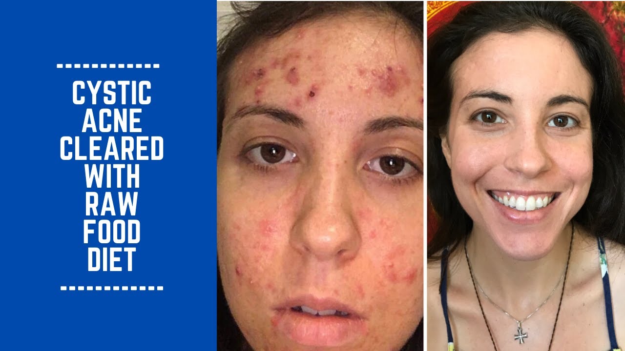 How Amanda Cleared up Cystic Acne with Raw Food Diet