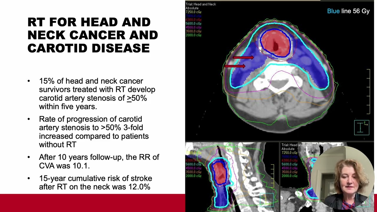 Radiation-induced micro- and macro vascular injury