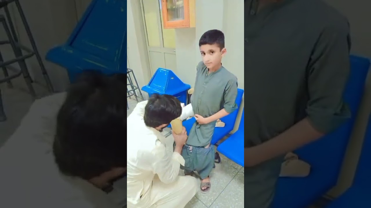 Aziz ullah trans femoral amputee Casting 🦿🦾 #foru #doctor #1milio #medicaldevices #legprosthesis