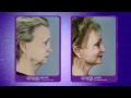 Premier image cosmetic  laser surgery atlanta tv commercial