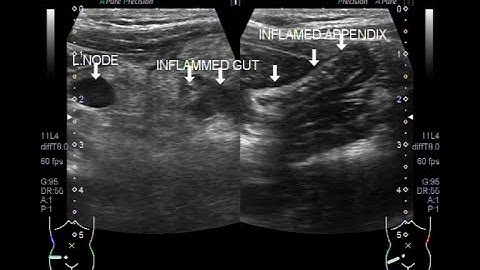 Ultrasound Video showing Inflamed gut, enlarged lymph node, and appendicitis in 10 years old child.