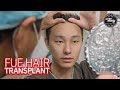 He Got a Hair Transplant in KOREA! [Part One]