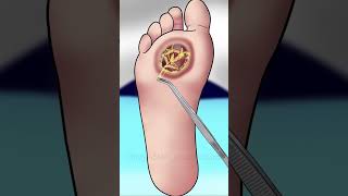 Maggots treatment for diabetic wound P 3 asmr animation satisfying trending viral shorts