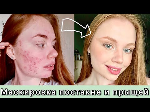 Как скрыть постакне и прыщи / Макияж для проблемной кожи