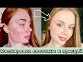 Как скрыть постакне и прыщи / Макияж для проблемной кожи