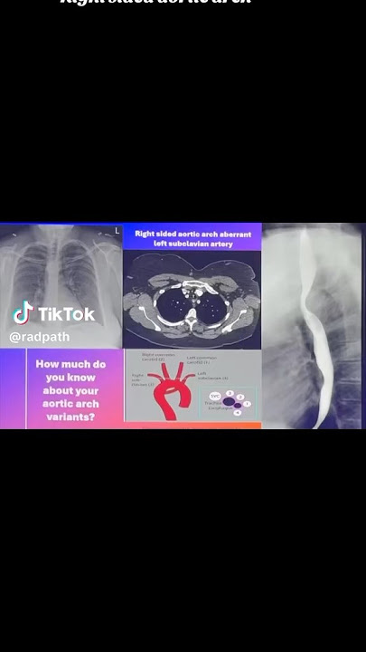 Right sided aortic arches and other aortic variants #congenitalheartdisease #aorta #medicalstudent