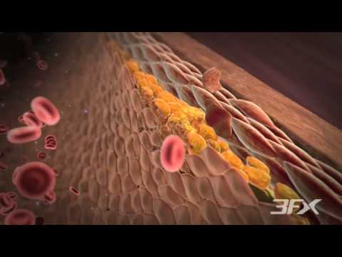 Video: Angiopathy Of The Lower Extremities, Hypertensive Angiopathy Of Blood Vessels