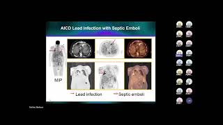 Webinar | NonInvasive Imaging For Infective Endocarditis in Patients w/ Prosthetic Cardiac Devices