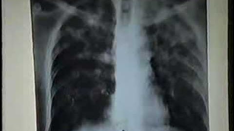 09 Mo Phoi 01[bacsihoasung.wordpress.com].wmv