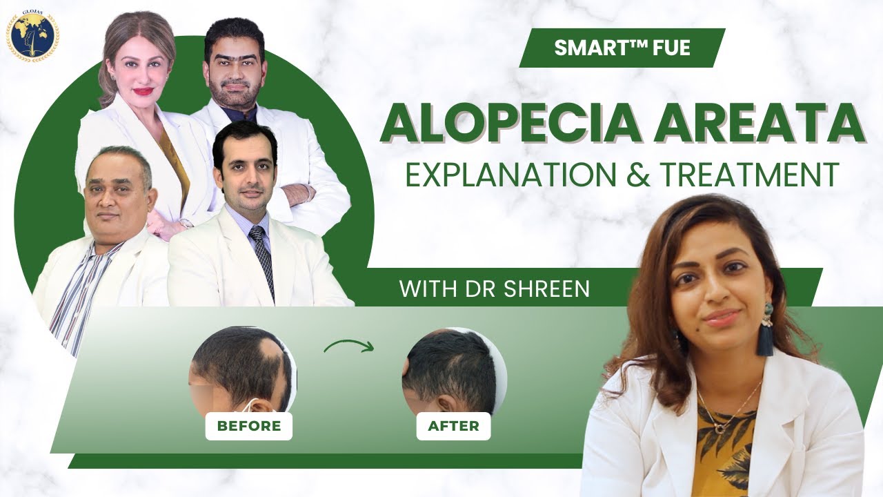 Understanding Alopecia Areata: Symptoms & Treatment with Dr. Shreen ...