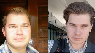 Truth About Finasteride: My 12 Year Update Results