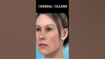 Dermal Fillers How it works? #shorts