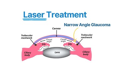What is Laser Peripheral Iridotomy (LPI)? Explained by Eye Doctor