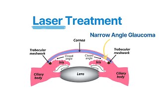 What is Laser Peripheral Iridotomy (LPI)? Explained by Eye Doctor