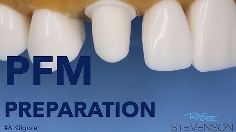PFM Preparation on The Canine Tooth #6 Kilgore | Stevenson Dental Solutions