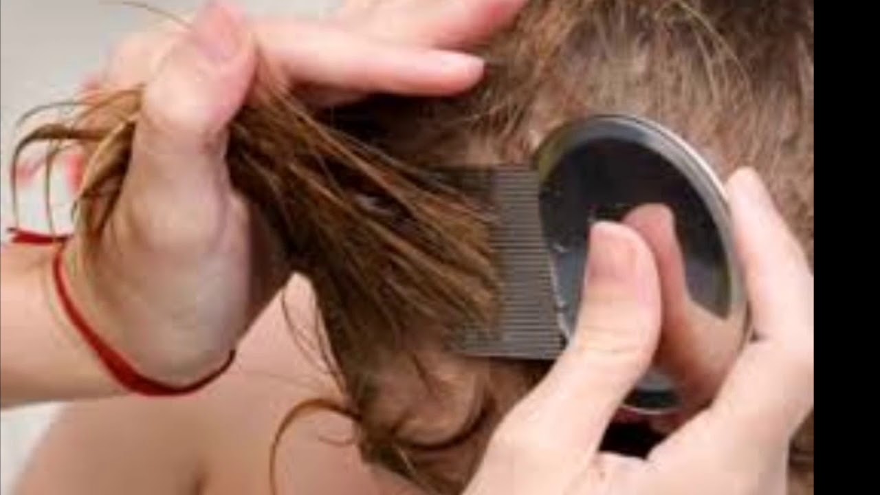 TRUCOS PARA ELIMINAR LOS PIOJOS RÁPIDAMENTE - YouTube