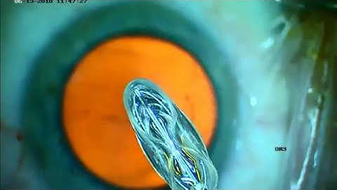 Dr. Ike Ahmed: ZEPTO® Precision Cataract Surgery Capsulotomy System. Video 1 of 2