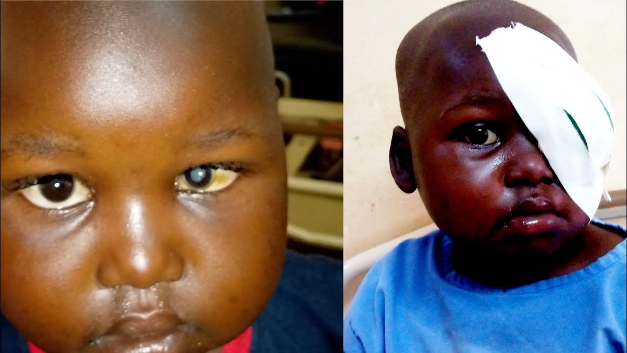 Baby Ezera's surgery of the eye was successful