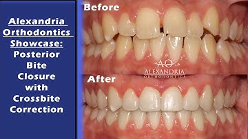 Alexandria Orthodontics Showcase:  Posterior bite closure with crossbite correction