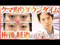 【40~50代必見】目の下のクマ取り ダウンタイム経過を症例を用いて徹底解説【クマ治療】