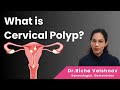 What is cervical polyp  causes and treatment  drricha vaishnav 