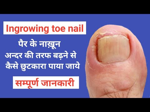 Ingrown Toenails से कैसे छुटकारा पाया जाए | ingrown toenails treatment | in hindi