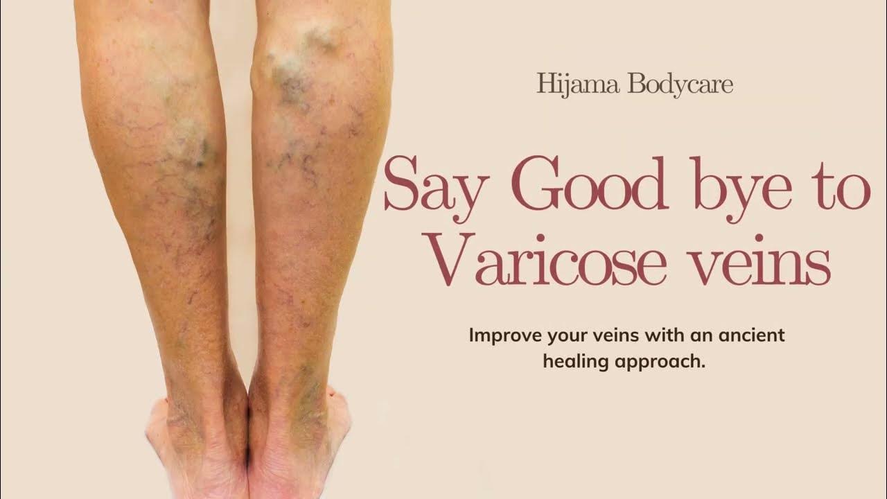 Say goodbye to varicose veins with a natural healing approach. Hijama