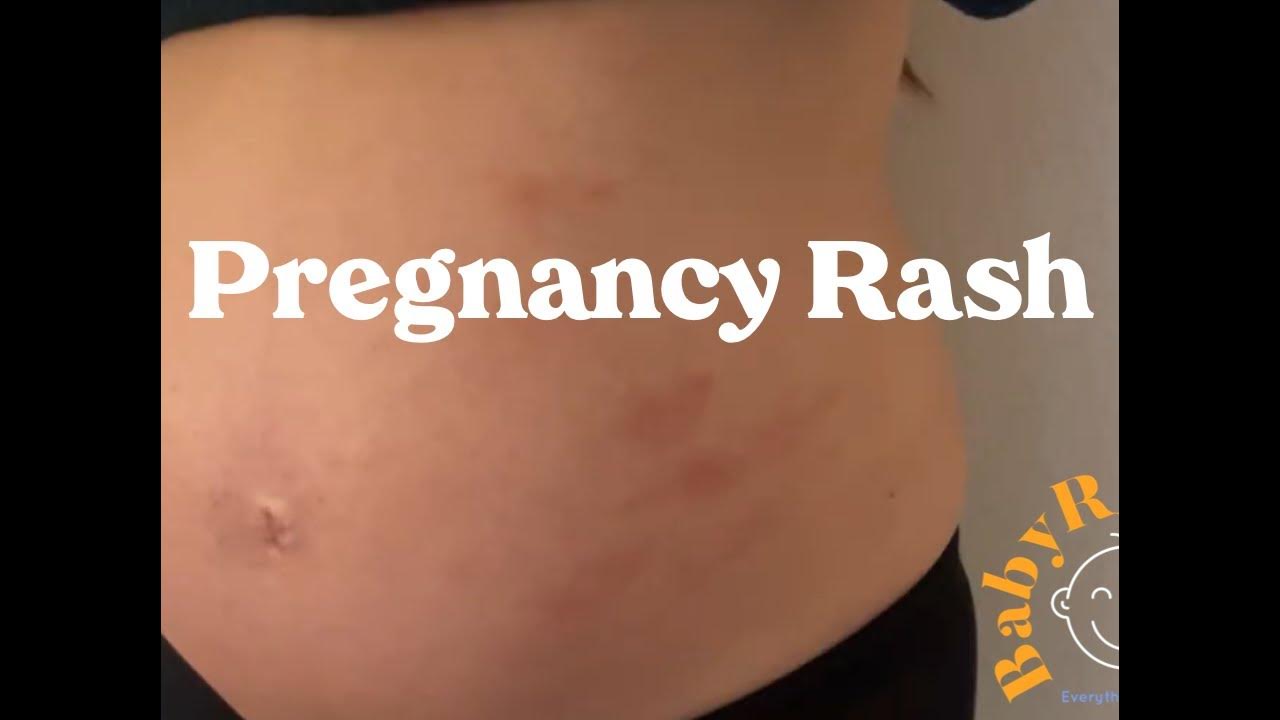 Early Pregnancy Rash On Chest