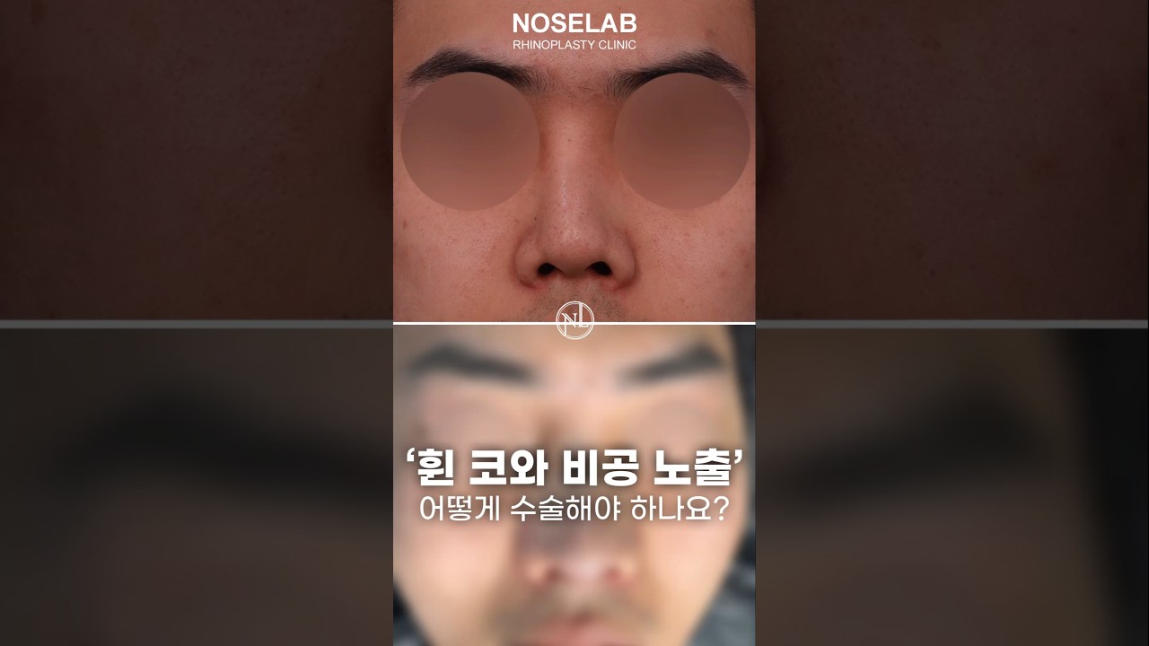 휜 코와 비공 노출, 비개방 재수술로 자연스럽게 교정하는 방법