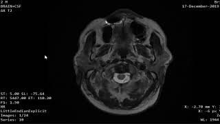 Case 1117 MRI CSF flowmetry brain atrophy