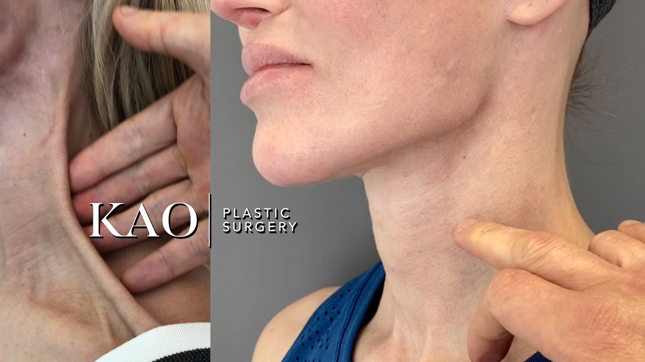 Ponytail Facelift Cost vs Botched Plastic Surgery? A Nightmare! YouTube