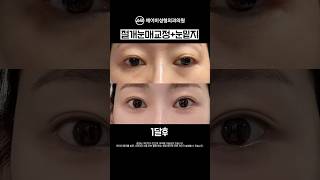 절개눈매교정+눈밑지방재배치 후기 #shorts