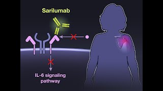 Sarilumab for Relapse of Polymyalgia Rheumatica | NEJM