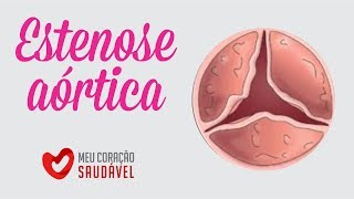 Estenose da de veia subclávia cirurgia