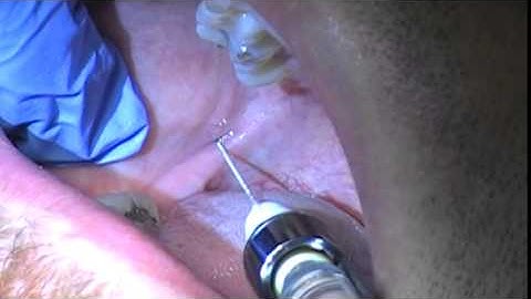 IA Injection Technique