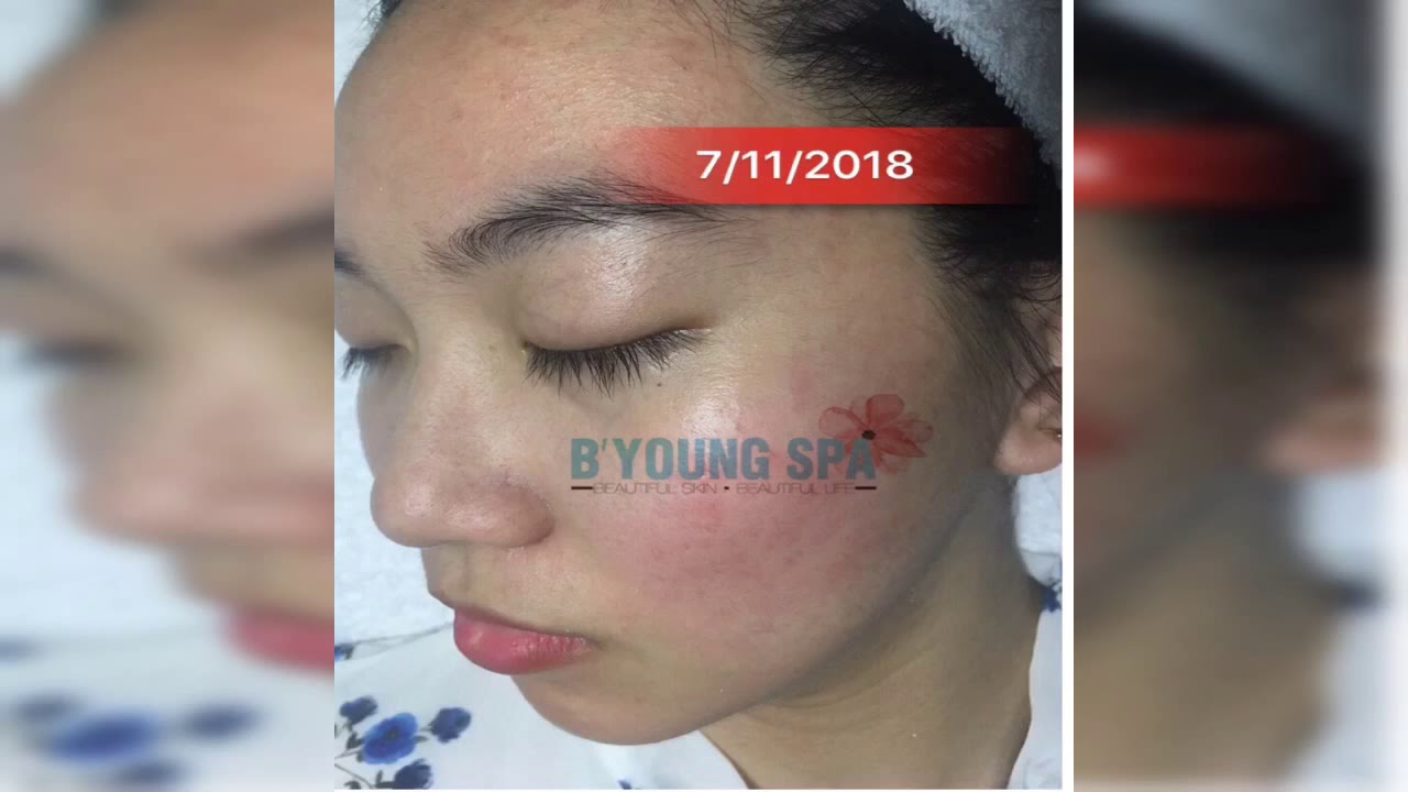 Acne treatment by B’Young Spa
