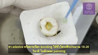 การใช้ระบบยึดติดแบบ 3-step etch-and-rinse
