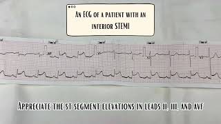 STEMI - ECG 