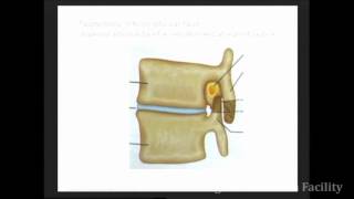 Posterior &amp; Transforaminal Lumbar Interbody Fusion (PLIF &amp; TLIF)