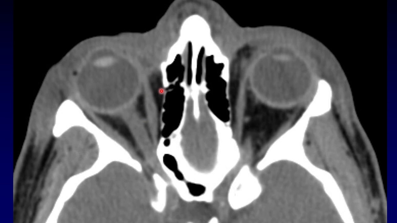 Imaging of the Eye and Orbit, Part 5