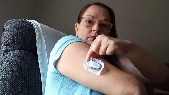 Dexcom G6 removal