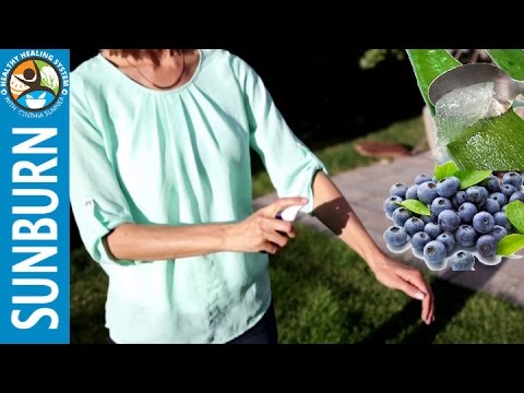 Home Remedies for Sunburn