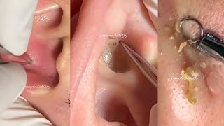 1 HOUR Of Pimple Popping Video Compilation