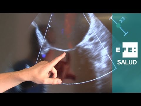 Video: Cómo diagnosticar la regurgitación mitral: 15 pasos (con imágenes)