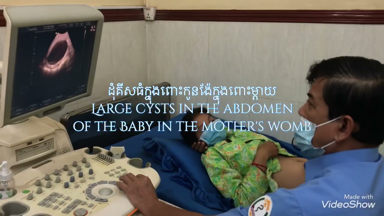 ដុំគីសធំក្នុងពោះកូនង៉ែតក្នុងពោះម្តាយLarge cysts in the abdomen of the Baby in the Mother's womb