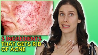 5 Best PIP/PIH Ingredients For Acne Hyperpigmentation & How They Work