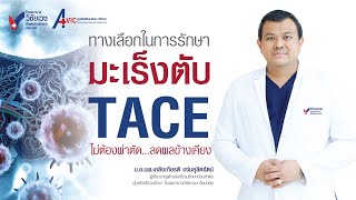 ทางเลือกในการรักษามะเร็งตับด้วย TACE ไม่ต้องผ่าตัด ลดผลข้างเคียง