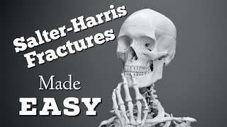 SalterHarris Fracture Classification System Mnemonic: Type 1, 2, 3, 4, 5: Quick & EZ [Episode 11]