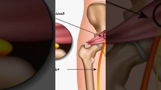 علاج عرق النسا بخمس دقائق عرق_النسا علاج صحة نصائح العصب_الوركي