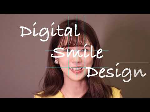 "DSD" 數位微笑美學設計 - [徐偉軒牙醫師] 網紅女神首選/微創美齒貼片/微笑曲線